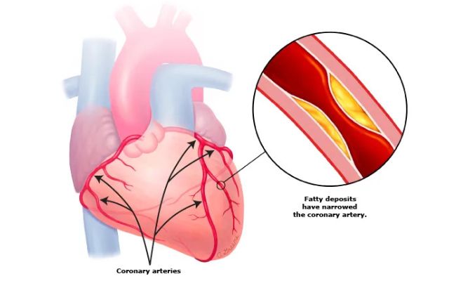 Coronary Heart Disease