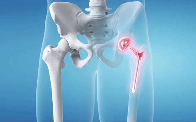 Joint Replacement Surgery