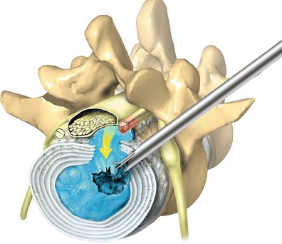 stitchless endoscopic spine surgery